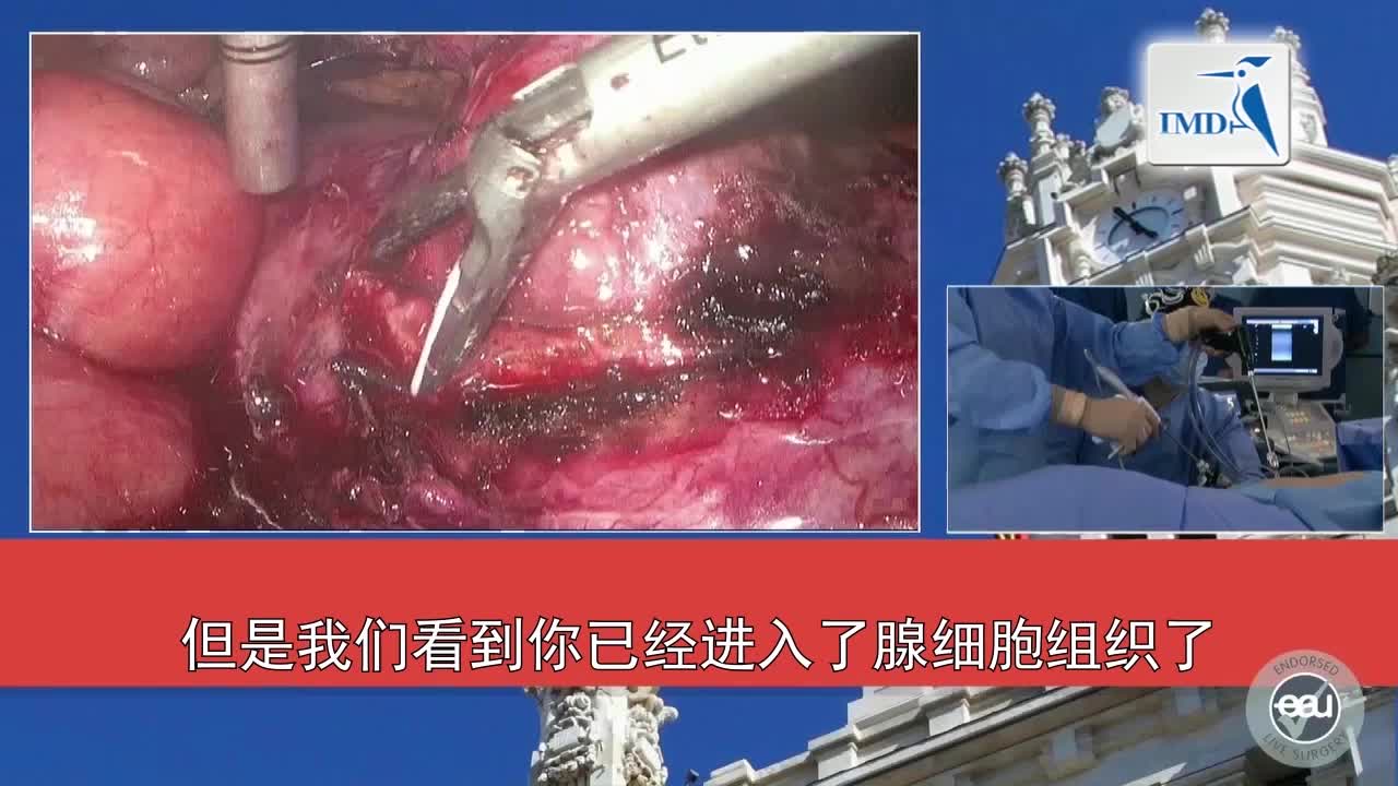 3D高清SPIES系统辅助腹腔镜部分肾切除术（2）