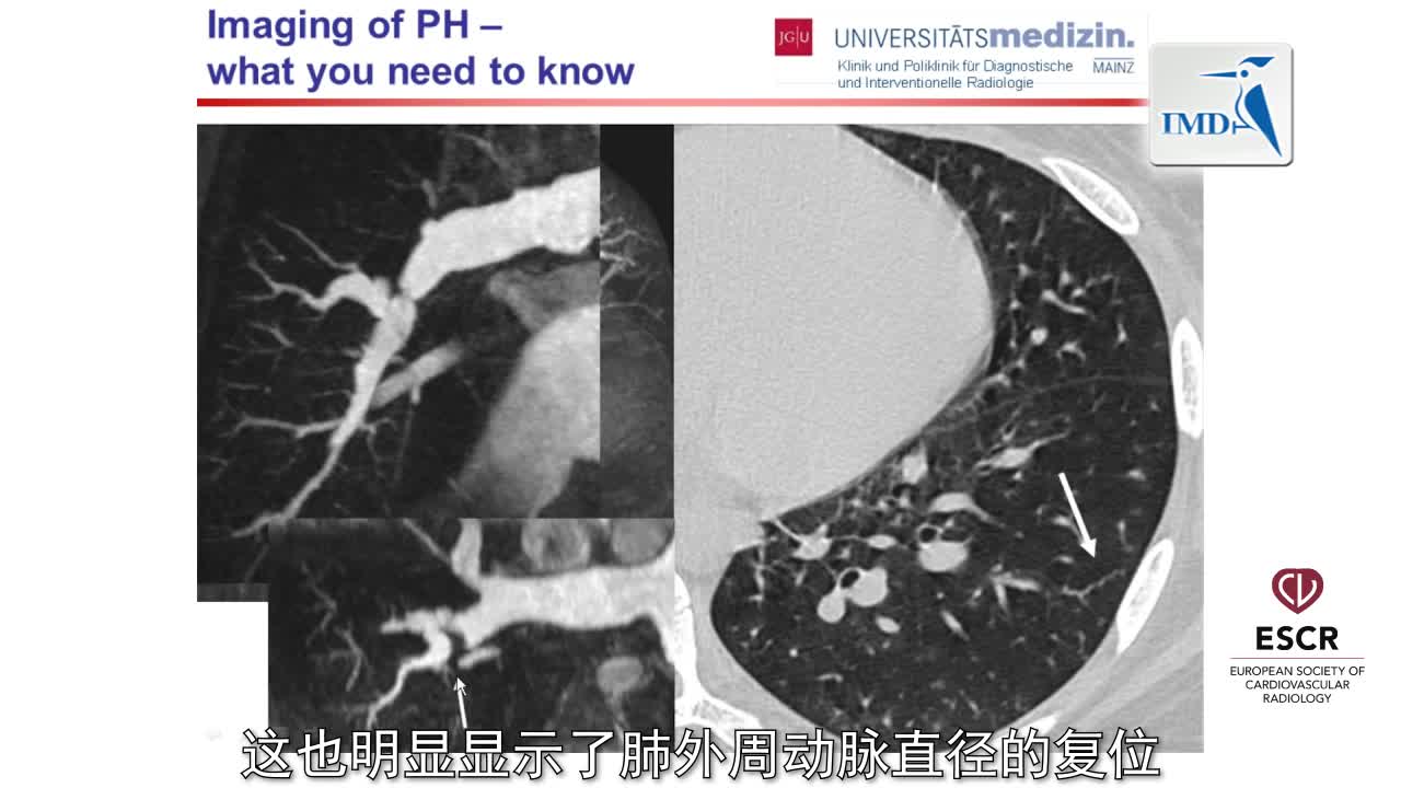 肺动脉高压显像（3）