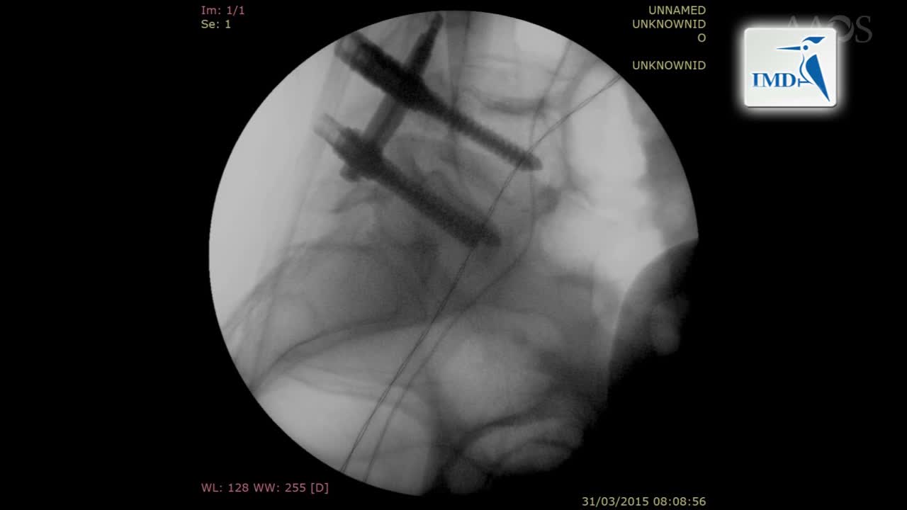 如何减轻严重不平衡狭窄性脊椎前移（4）