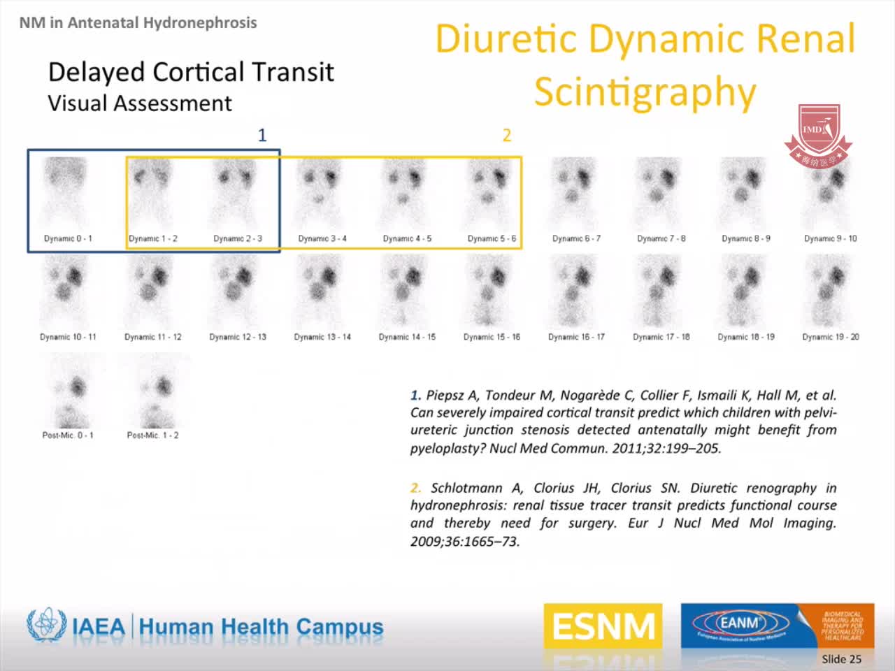 儿科：产前肾积水的核医学评价3