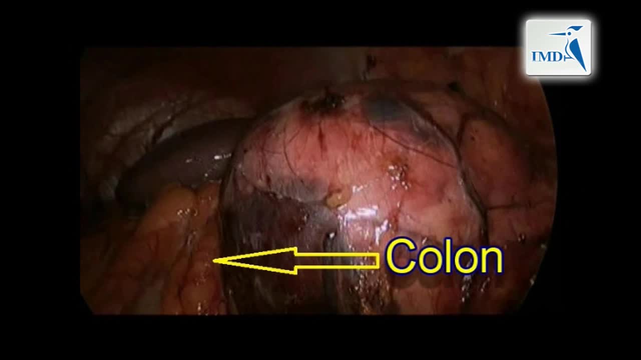 治疗大型血管肌脂瘤手术中肾筋膜外部分肾切除