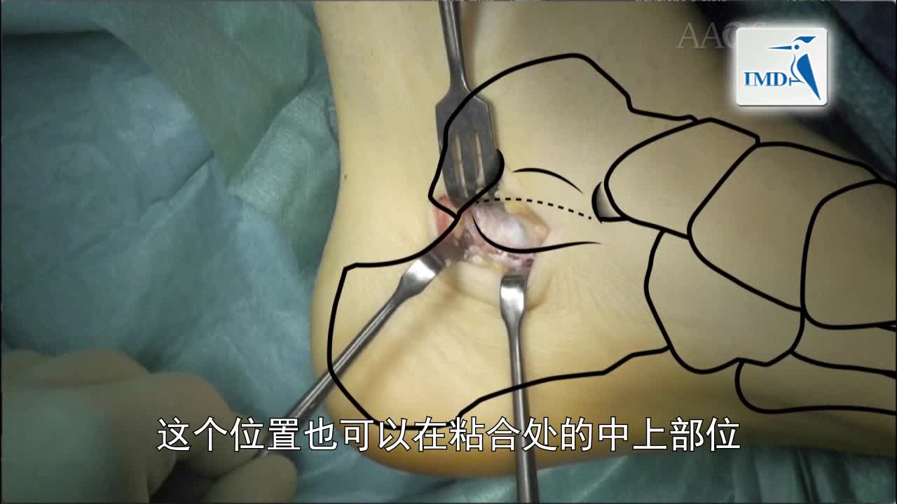 儿童易变性平足症的手术疗法：距骨下关节制动术及复合型手术（4）