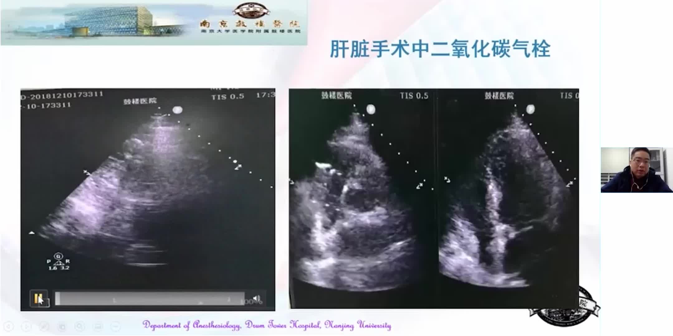 非心脏手术中的超声诊断案例分享