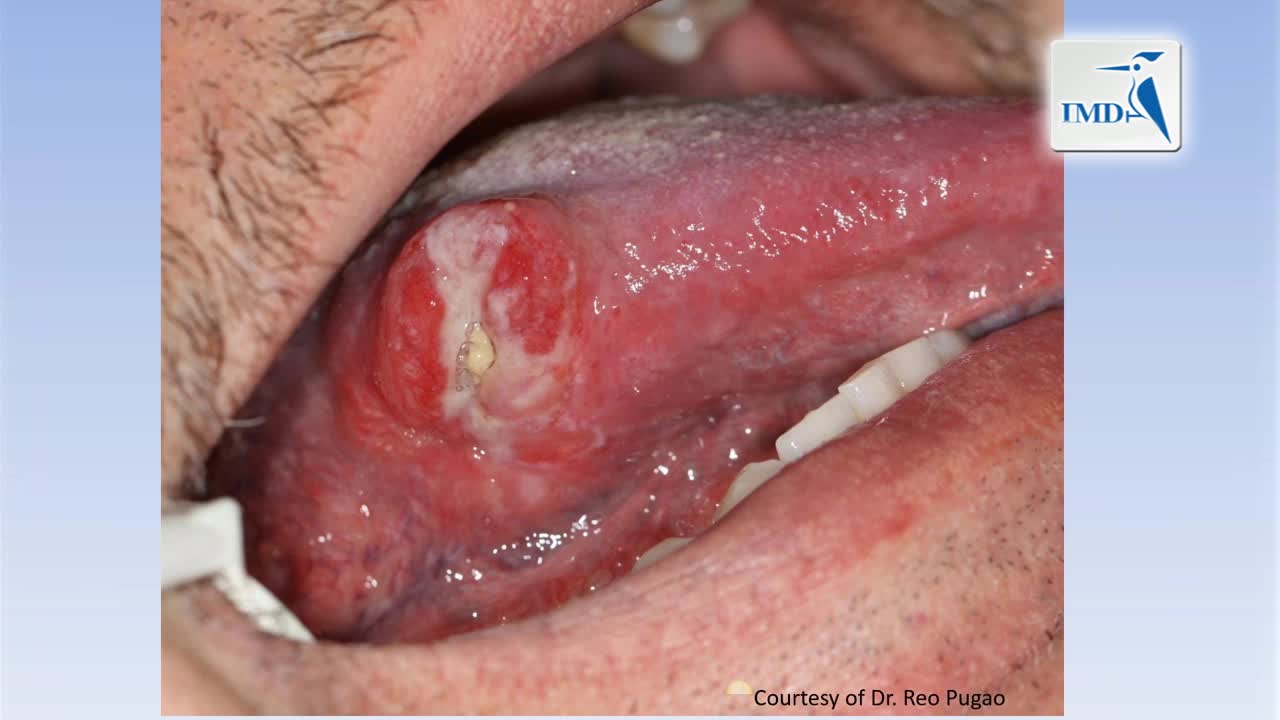 人乳突瘤病毒及口咽癌（1）