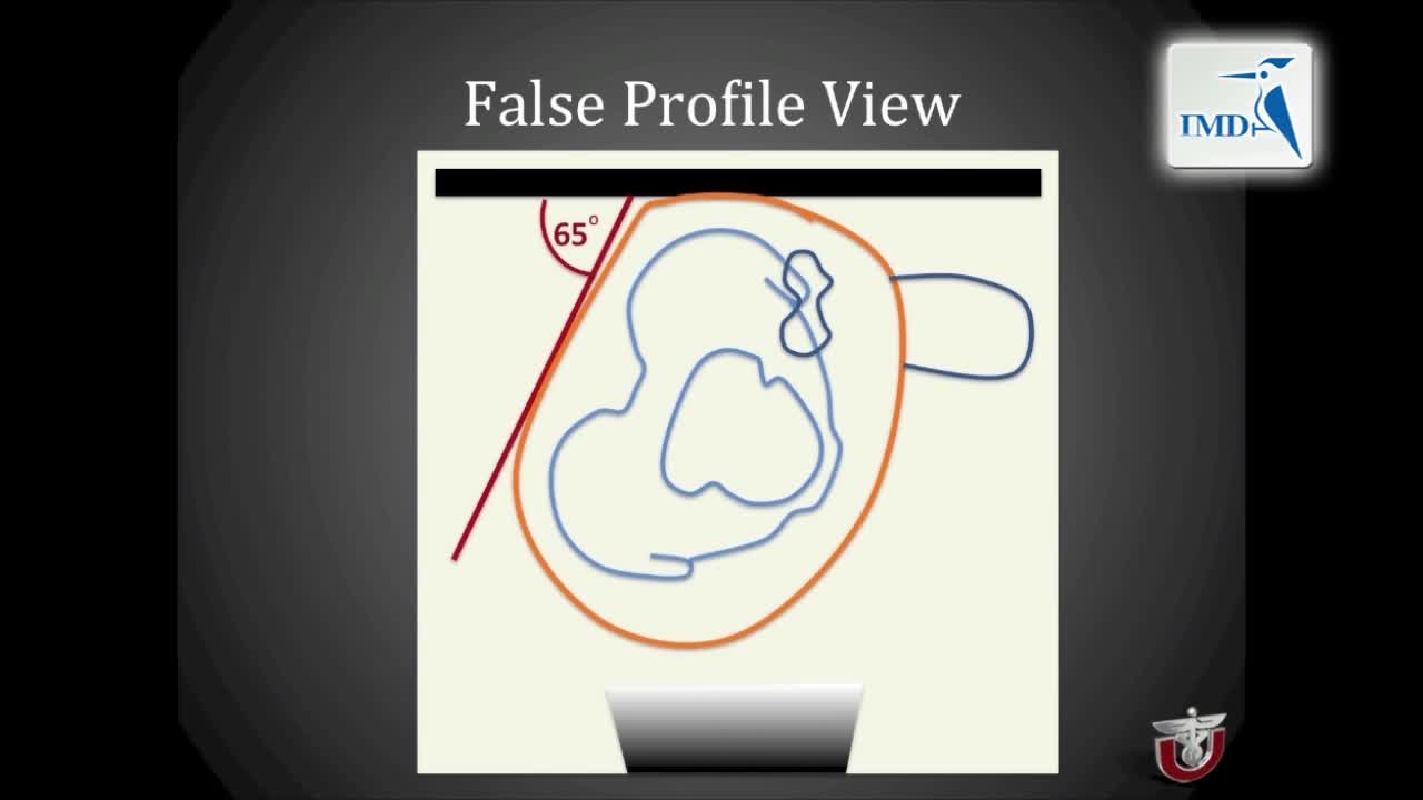 股直肌保留髋臼周围截骨手术（预告）