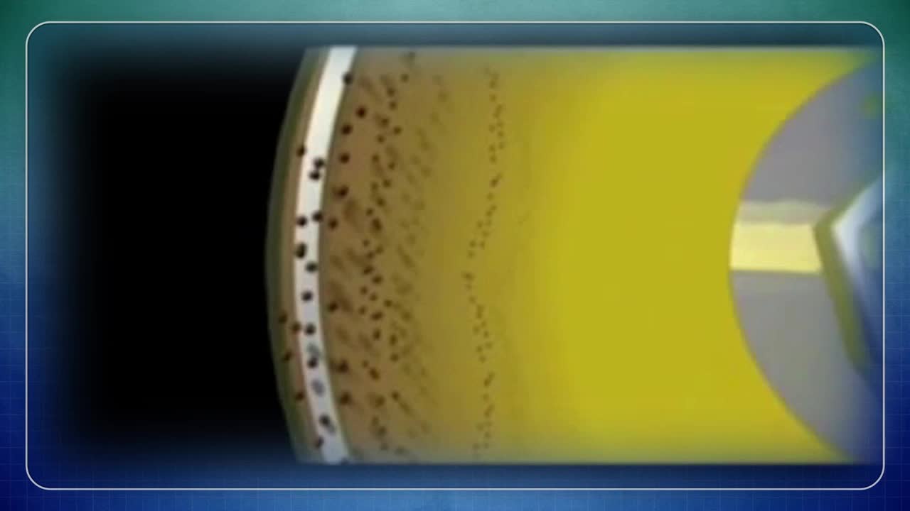 Minimally Invasive Procedure Mimics Pancreas Transplantation