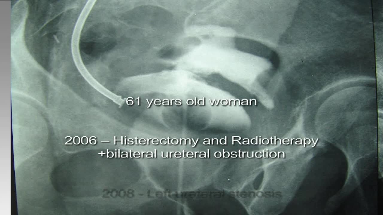 Bilateral retroperitoneal laparoscopic nephrectomy using ..-