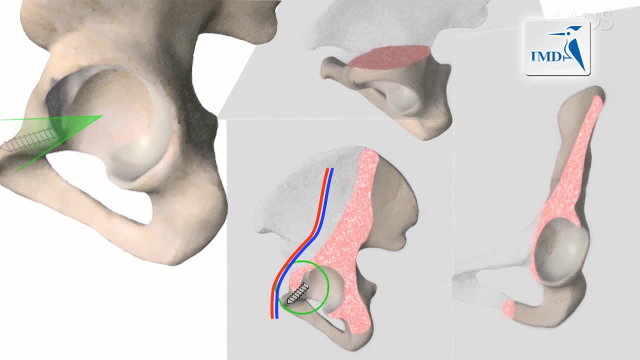 微创直接前部方式下髋臼假体修正（4）