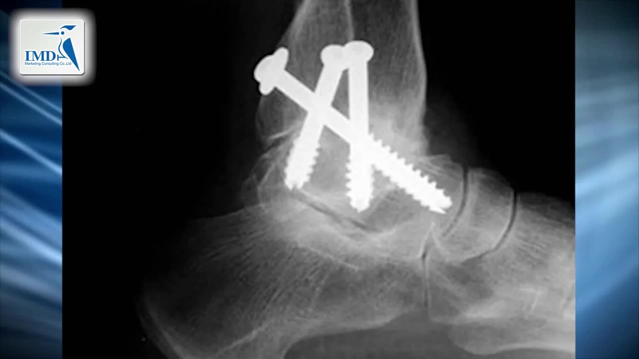 脚踝全关节置换术