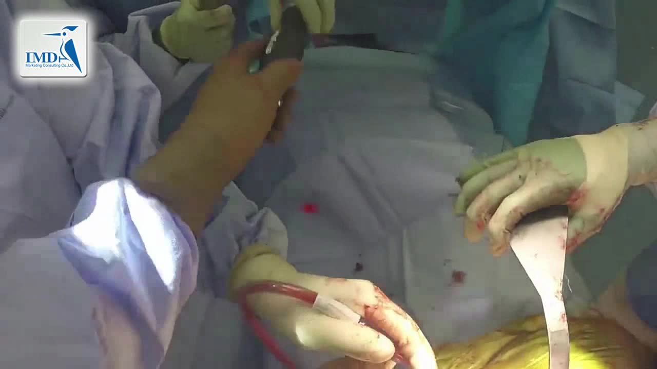 后入路髋关节微创手术（3）