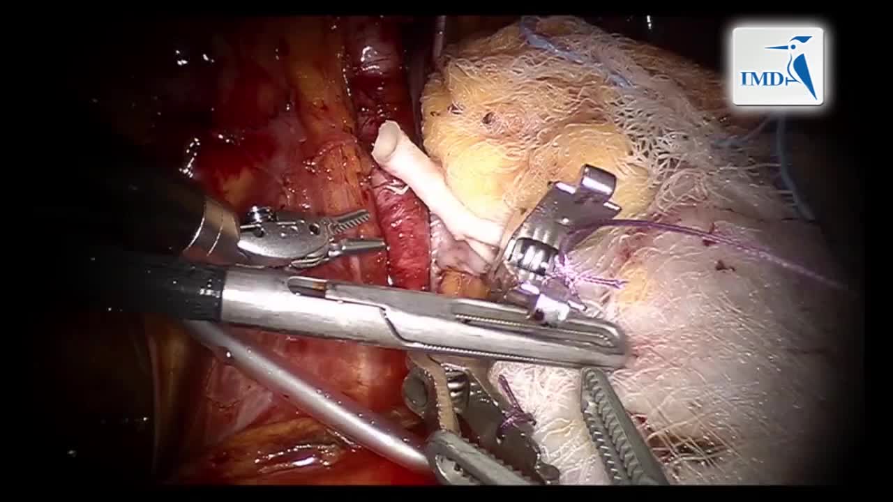 经阴道途径行活体供肾和肾移植的纯机器人辅助方法（2）