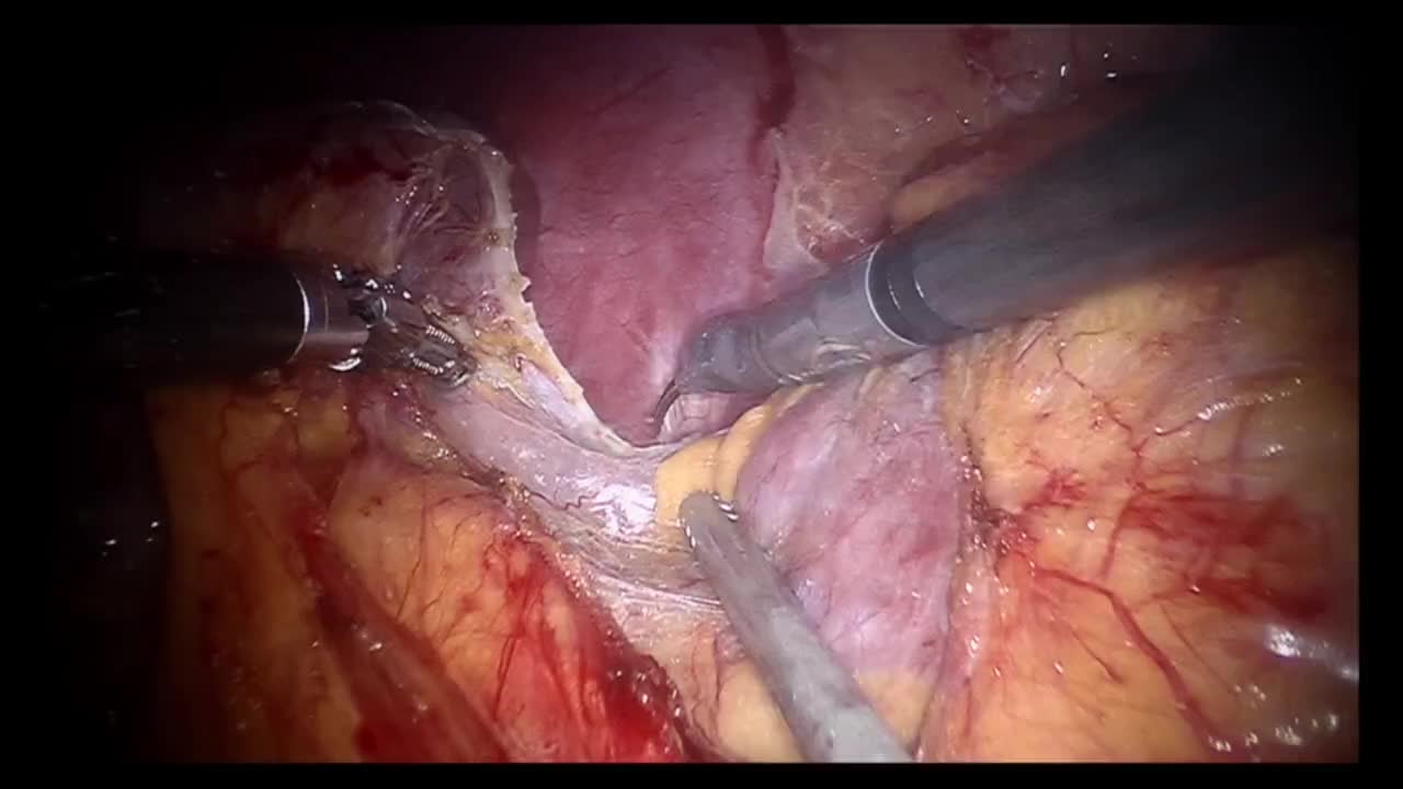 A new surgical area opened in renal transplantation, A pu..-