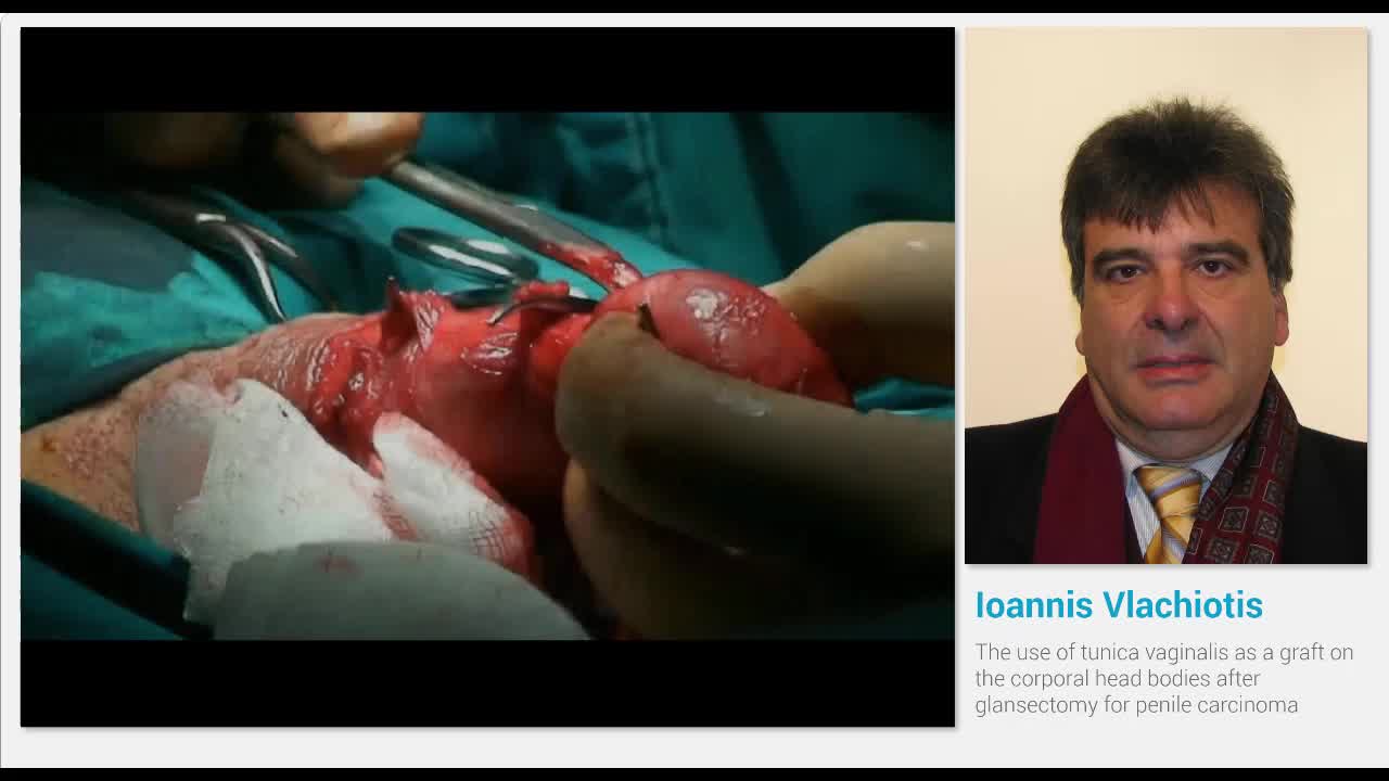 The use of tunica vaginalis as a graft on the corporal he..-