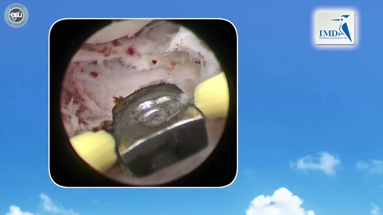 经尿道双极前列腺剜除术（2）