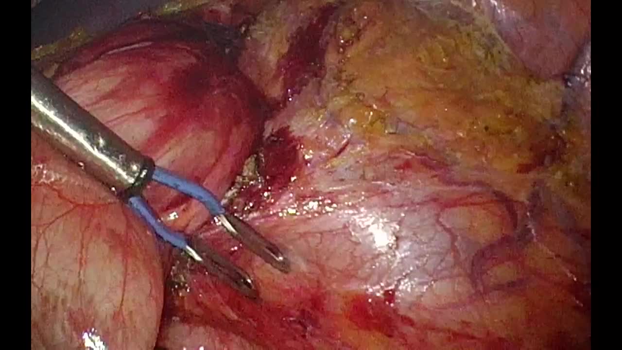 Aorto mesenteric compression of the left renal vein. Lapa..-