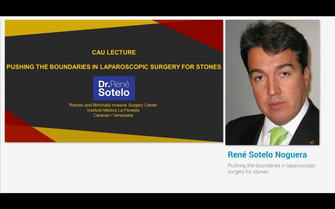 Pushing the boundaries in laparoscopic surgery for stones