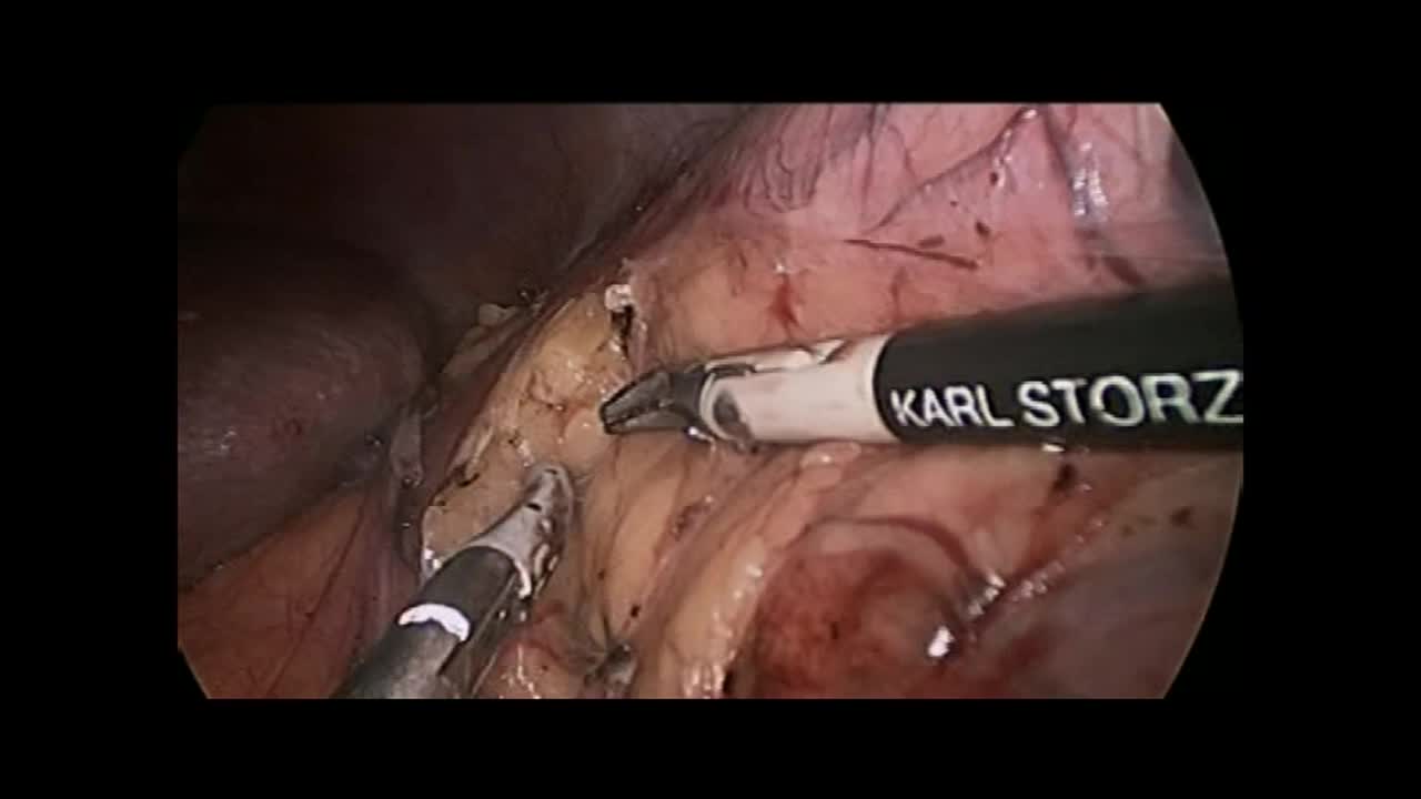 Extra-Gerota's fascia partial nephrectomy for angiomyolip..-