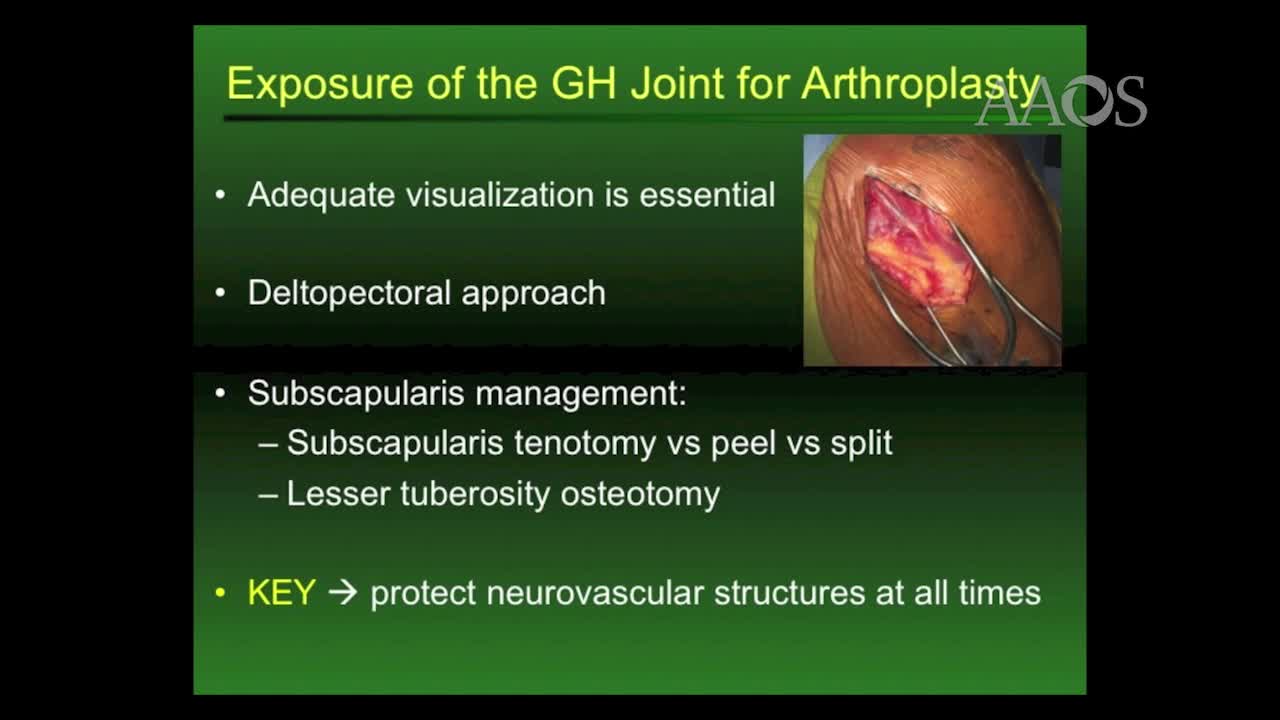 Exposure of the Glenohumeral Joint for Shoulder Arthroplasty