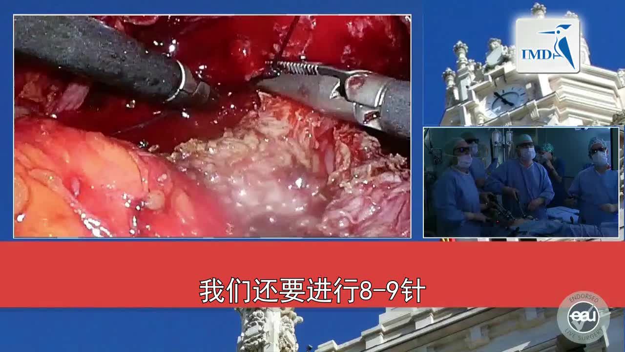 3D腹腔镜腹膜外根治性前列腺切除手术（6）