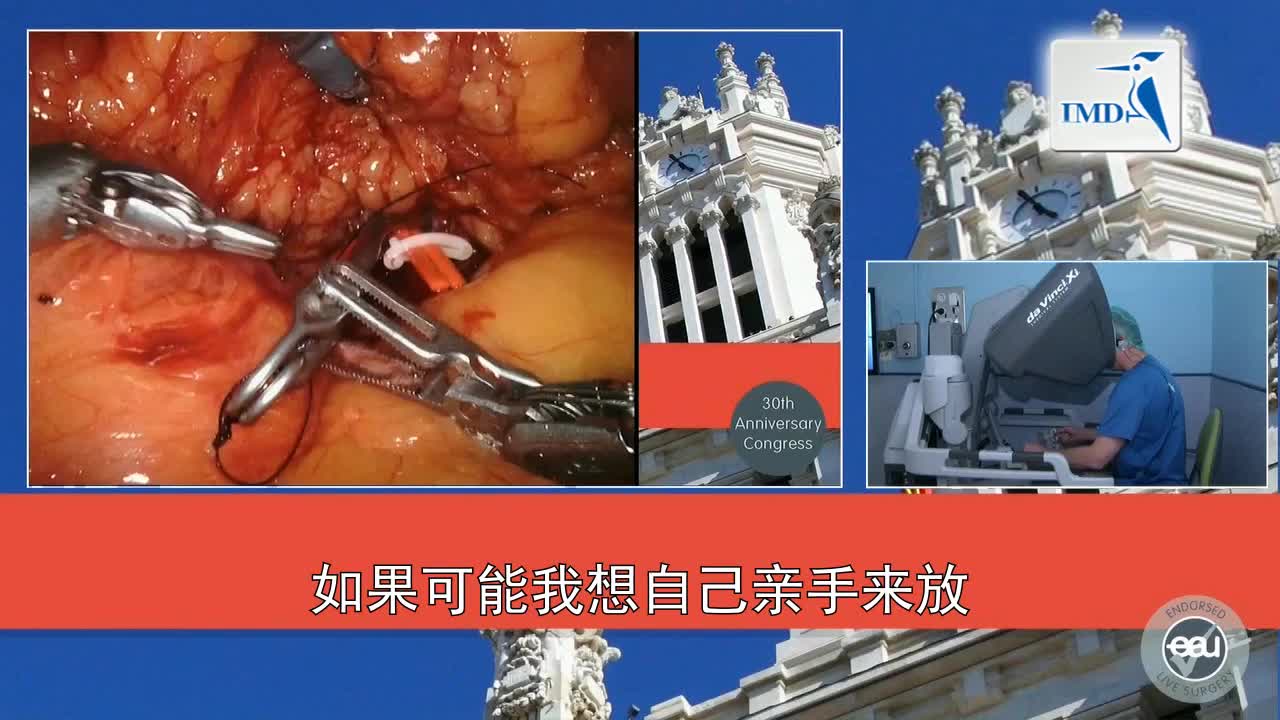 机器人辅助吲哚氰绿染色肾部分切除术（2）