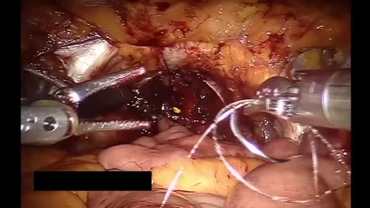 IAI (intuitive anatomical intracorporeal) neobladder tech..-