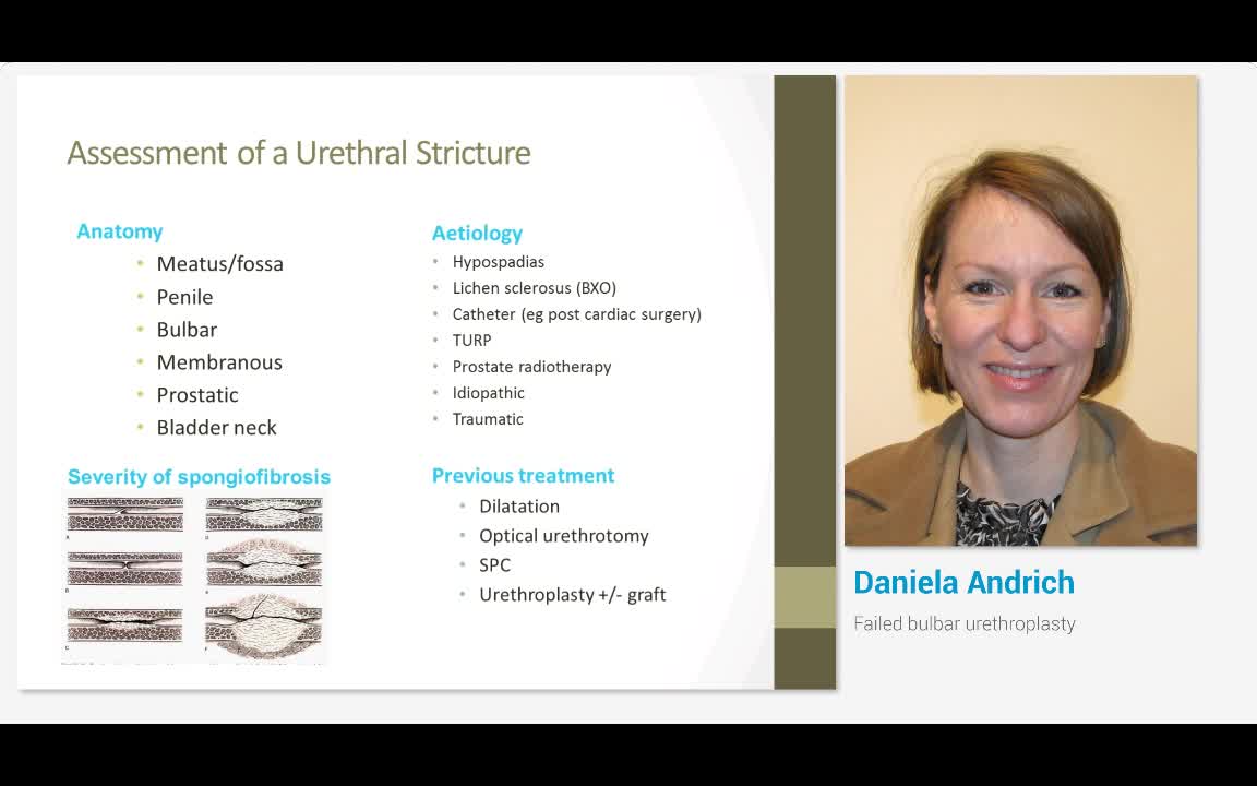 Failed bulbar urethroplasty