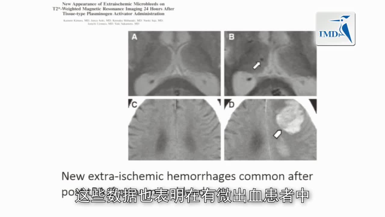 老年群体急性卒中治疗（4）