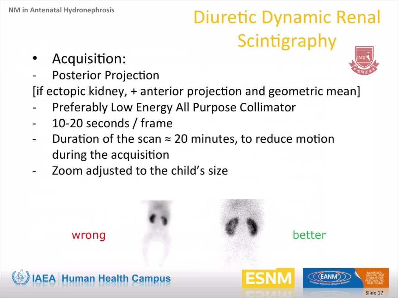 儿科：产前肾积水的核医学评价2