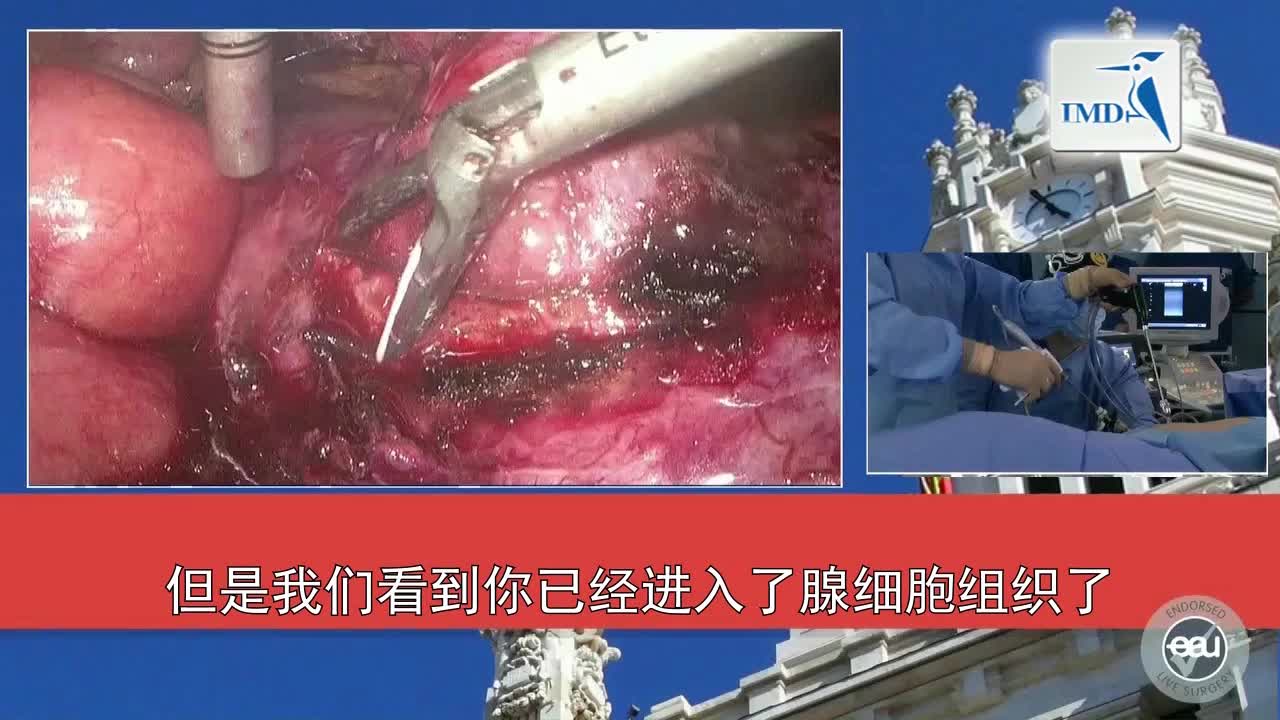 3D高清SPIES辅助腹腔镜部分肾切除术（2）