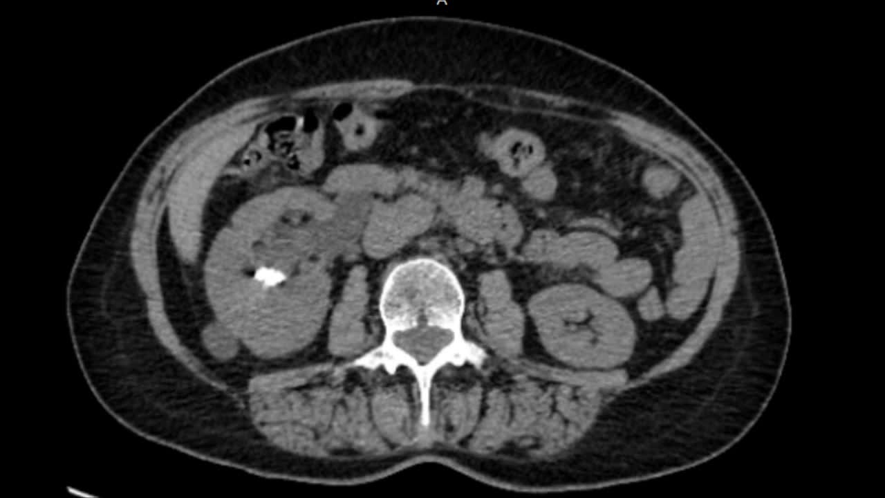 Laparoscopic pyeloplasty in patient with an incomplete do..-