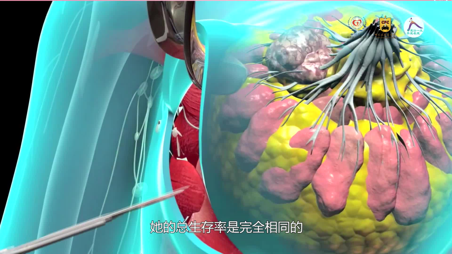 乳腺保乳手术适合哪些患者？--谢晖