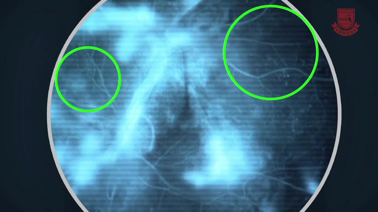 注射药物作为糖尿病眼病的替代疗法