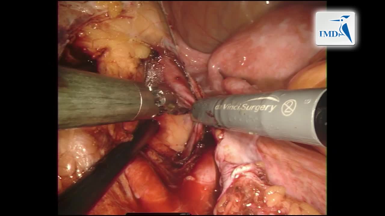 01_经阴道肾移植机器人手术