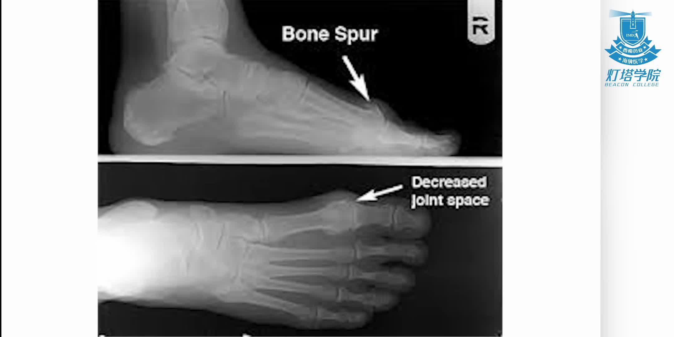 大脚趾关节炎的诊断和治疗