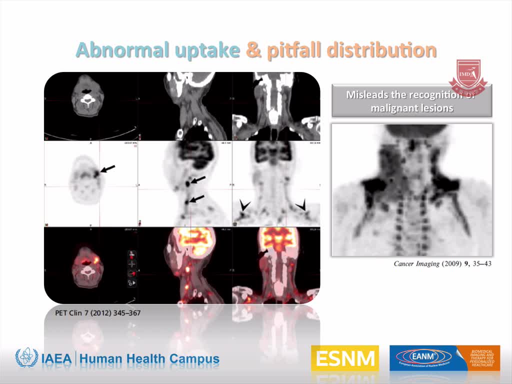 儿科：PET CT的缺陷2