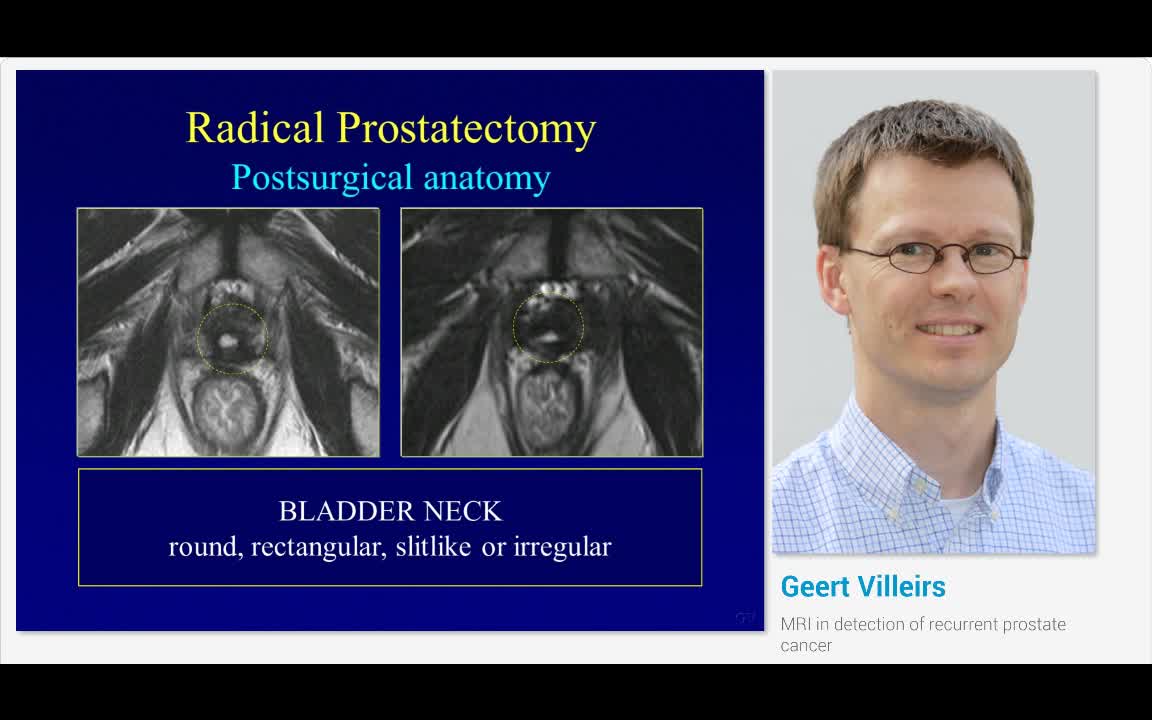 MRI in detection of recurrent prostate cancer