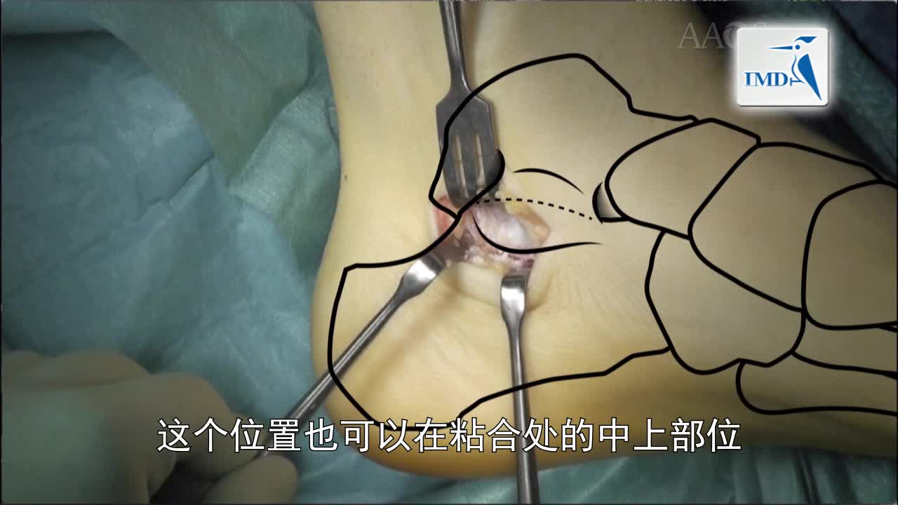 儿童易变性平足症手术治疗方法（4）