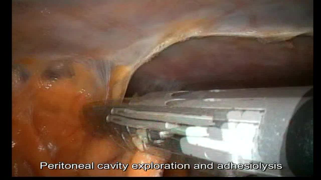 Laparoscopic treatment in renal cell carcinoma with venou..-