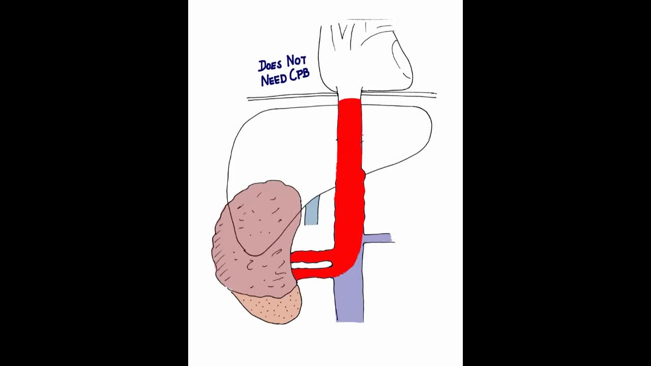 Laparoscopic approach to management of inferior vena cava..-