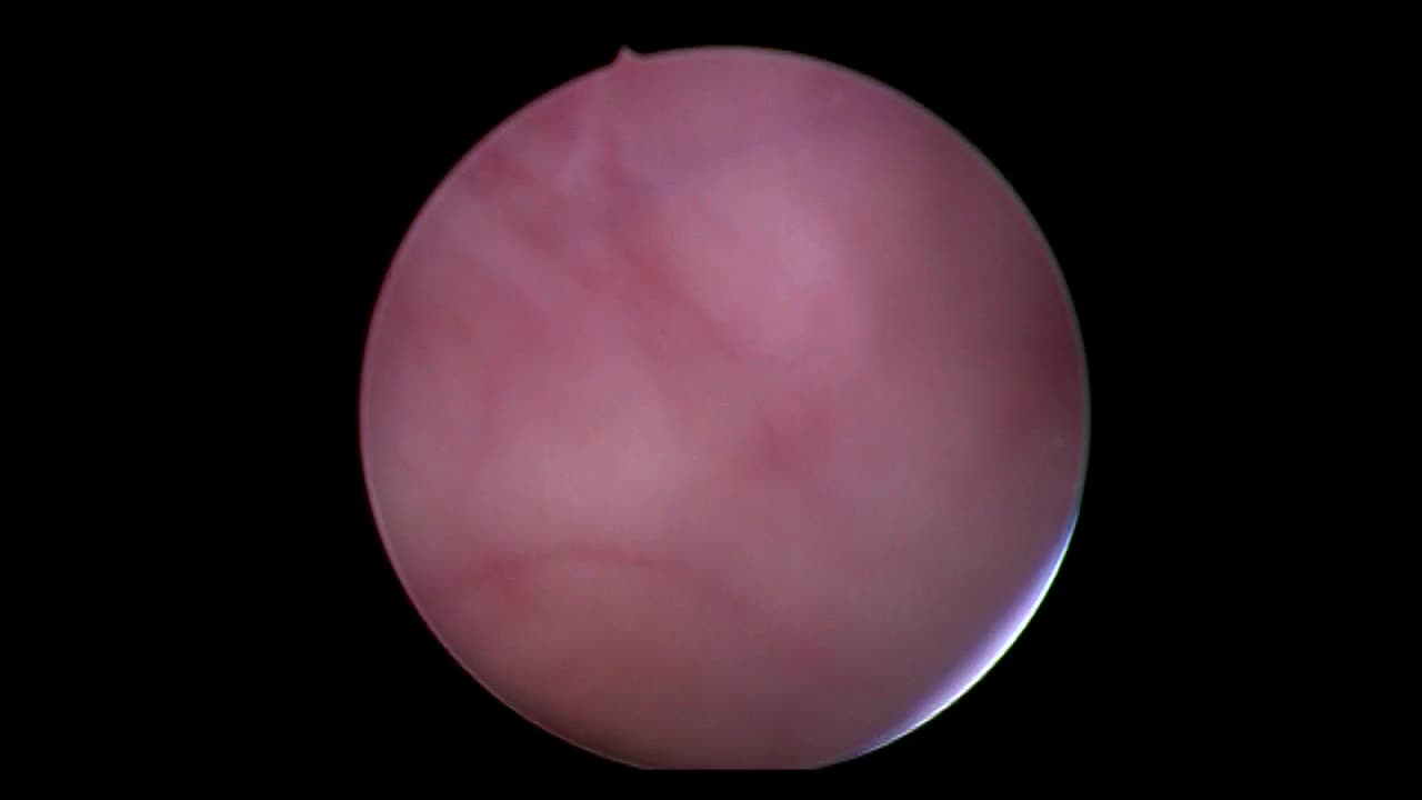 NOTES-assisted laparoscopic transvesical bladder divertic..-