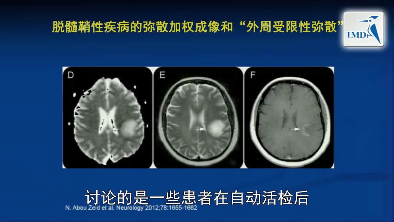 MRI与MS：一幅图是否值得冗言赘述（2）
