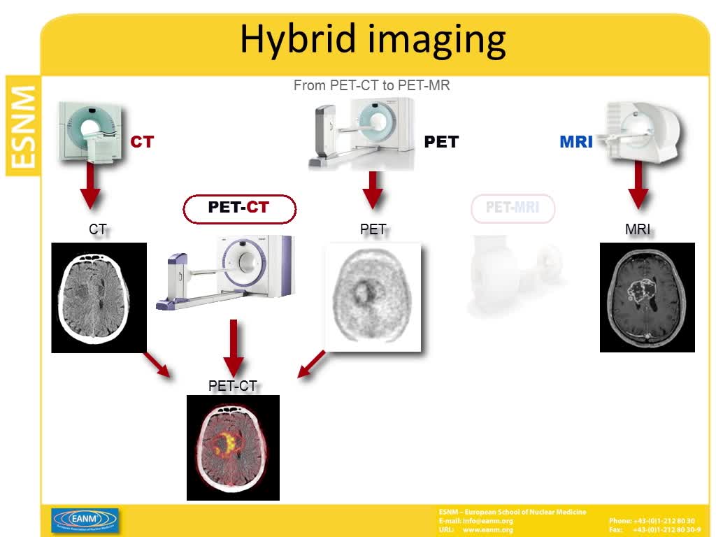 前列腺癌的PET-MRI表现