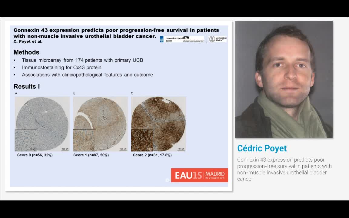 Connexin 43 expression predicts poor progression-free sur..-