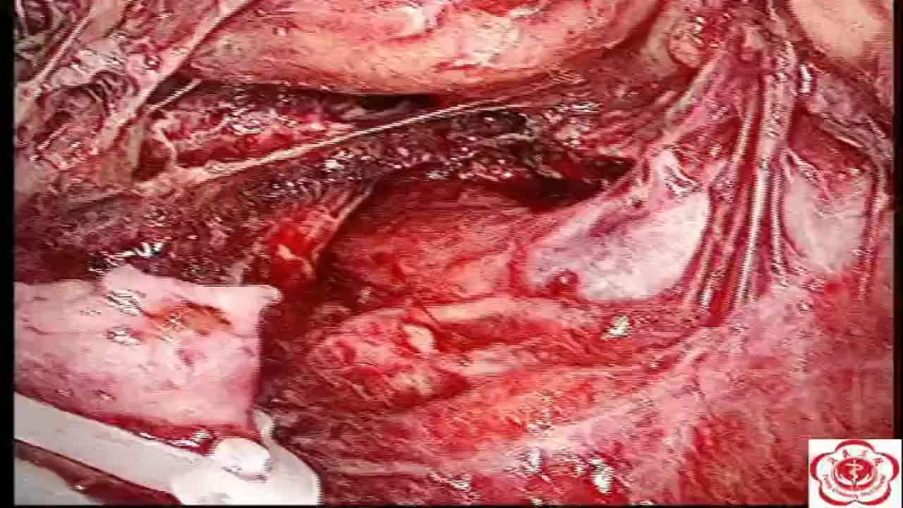 Laparoscopic resolution of vascular complications in retr..-