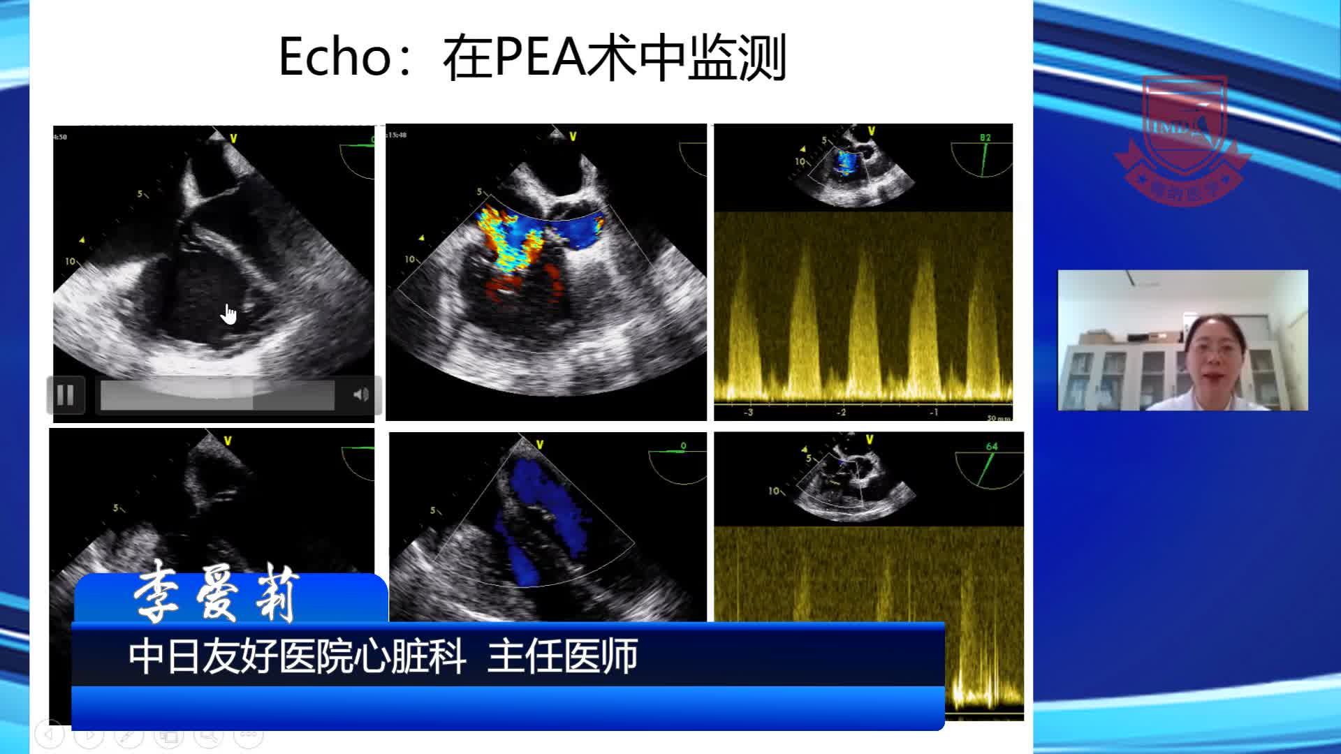 右心功能的超声心动图评估--李爱莉4