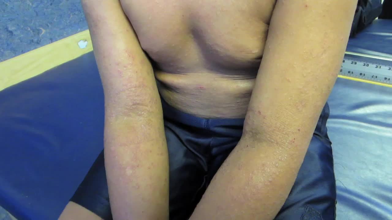 患有皮肤苔藓样硬化和丘疹的 6 岁男孩