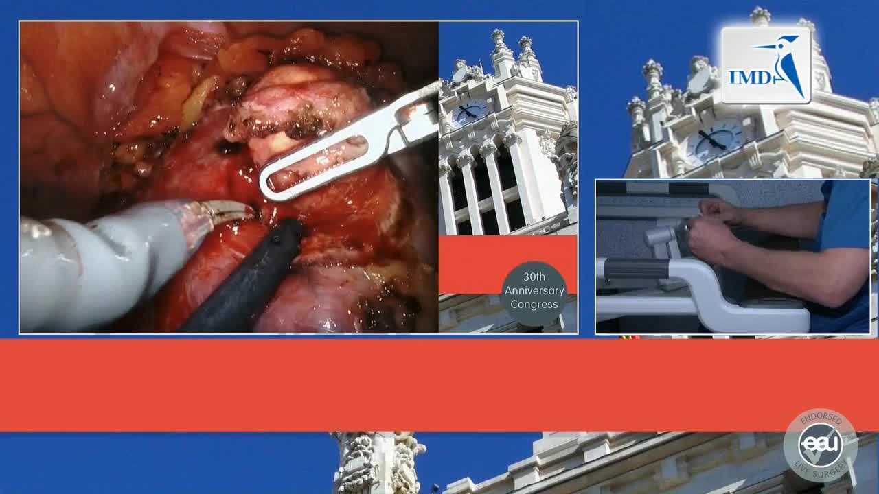 机器人辅助吲哚氰绿染色肾部分切除术（3）