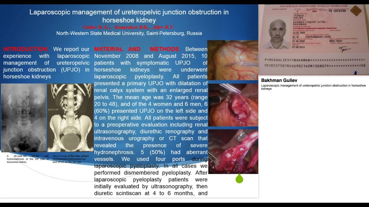 Laparoscopic management of ureteropelvic junction obstruc-