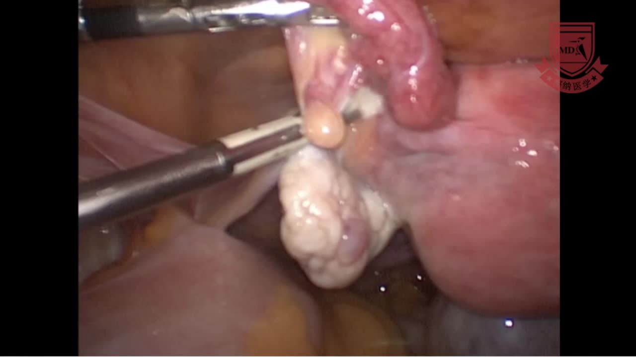 董丽霞--腹腔镜下子宫全切术