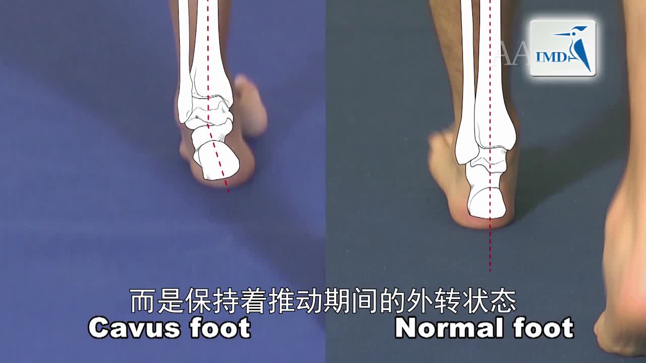 恰克-马利-杜斯氏症中高弓足的手术治疗（1）